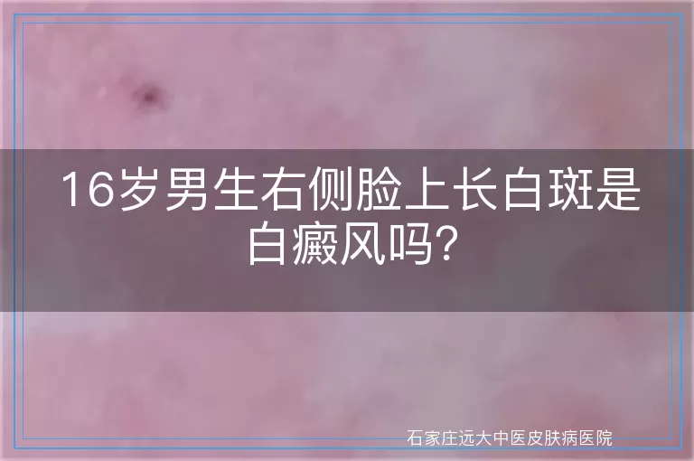 16岁男生右侧脸上长白斑是白癜风吗？