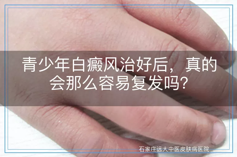 青少年白癜风治好后，真的会那么容易复发吗？