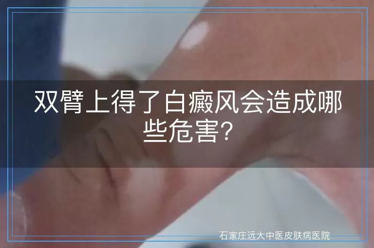 双臂上得了白癜风会造成哪些危害?