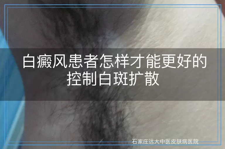 白癜风患者怎样才能更好的控制白斑扩散