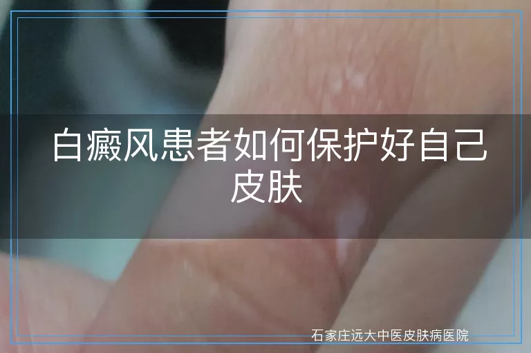 白癜风患者如何保护好自己皮肤