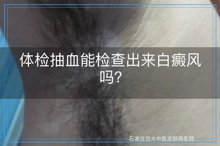 体检抽血能检查出来白癜风吗？