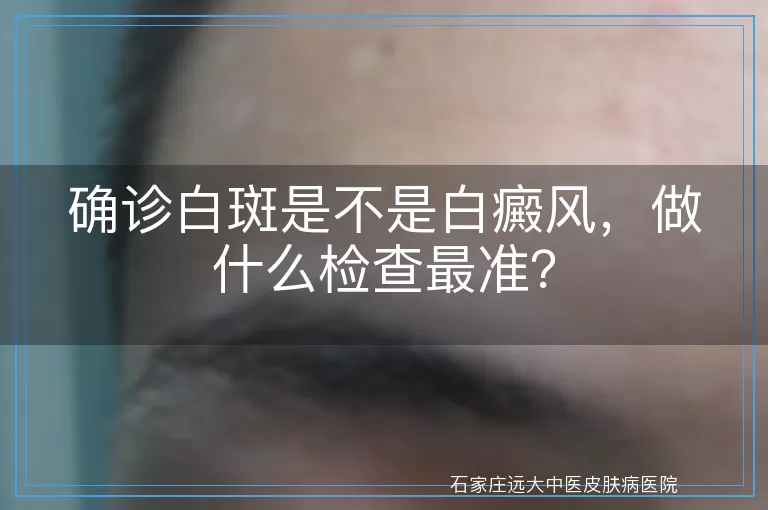 确诊白斑是不是白癜风，做什么检查最准？