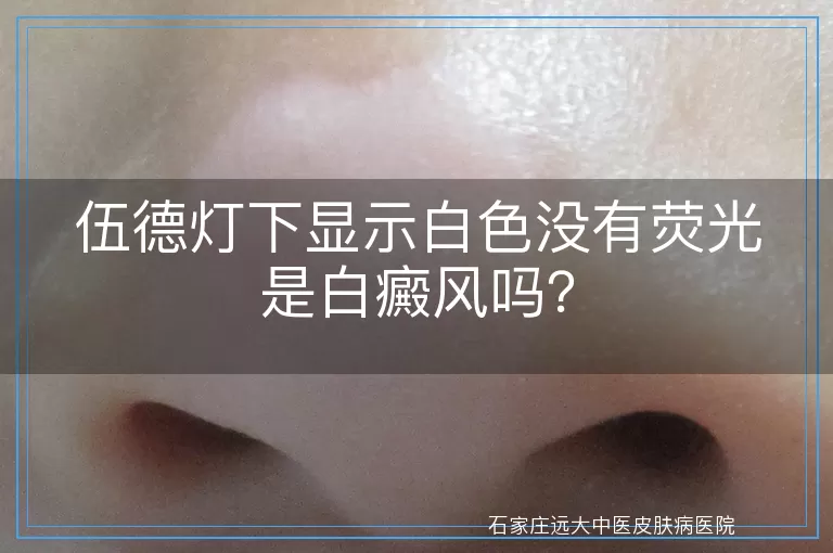 伍德灯下显示白色没有荧光是白癜风吗？