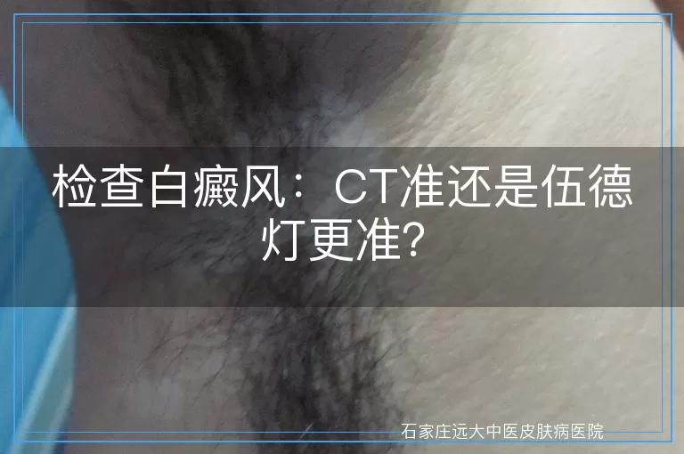 检查白癜风：CT准还是伍德灯更准？