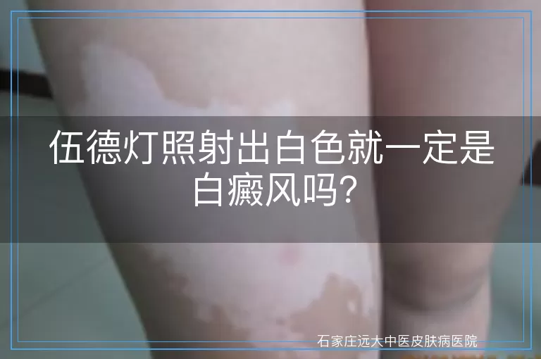 伍德灯照射出白色就一定是白癜风吗？