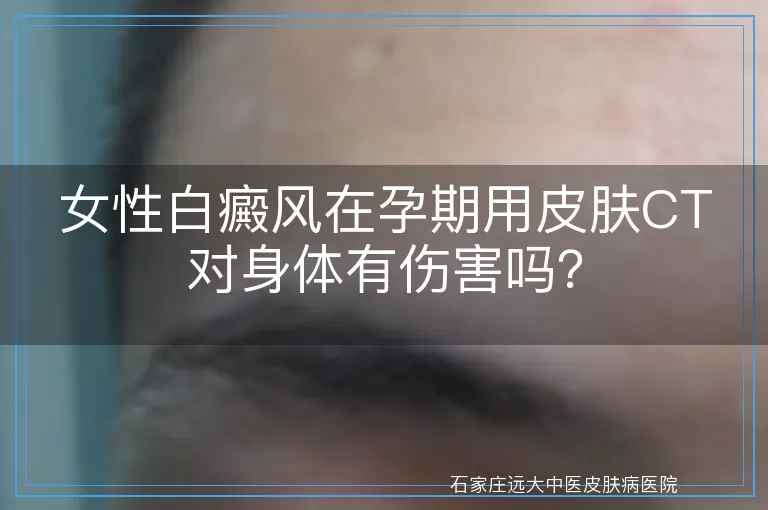 女性白癜风在孕期用皮肤CT对身体有伤害吗？