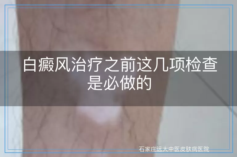 白癜风治疗之前这几项检查是必做的