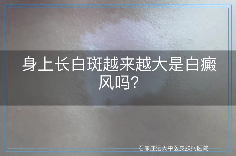 身上长白斑越来越大是白癜风吗？