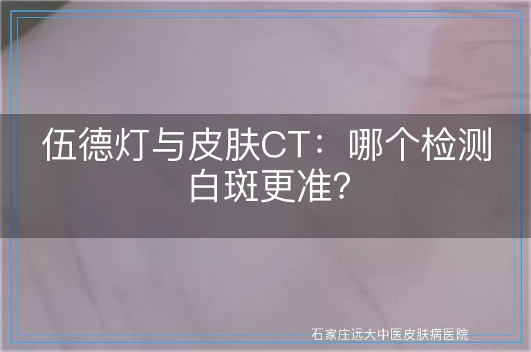 伍德灯与皮肤CT：哪个检测白斑更准？