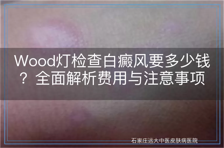 Wood灯检查白癜风要多少钱？全面解析费用与注意事项