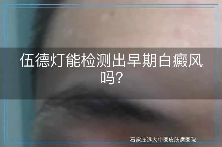 伍德灯能检测出早期白癜风吗？