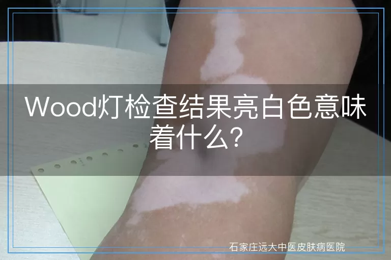 Wood灯检查结果亮白色意味着什么？