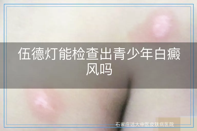 伍德灯能检查出青少年白癜风吗