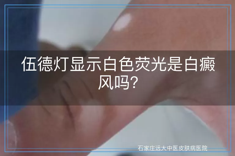 伍德灯显示白色荧光是白癜风吗？