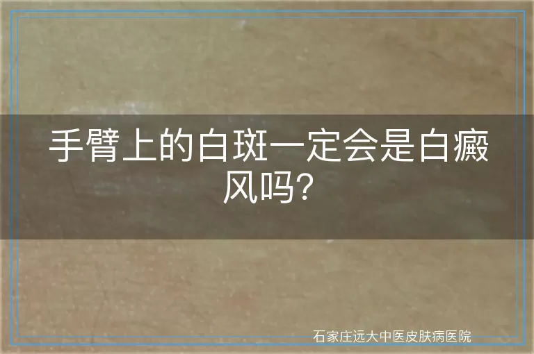 手臂上的白斑一定会是白癜风吗？