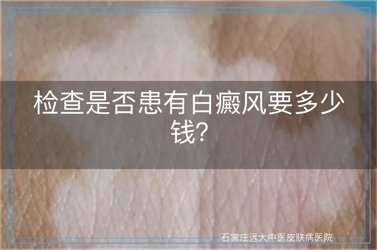 检查是否患有白癜风要多少钱？