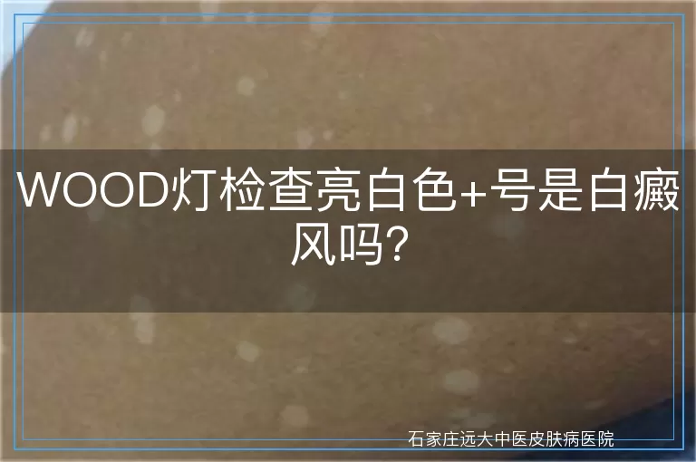 WOOD灯检查亮白色+号是白癜风吗？