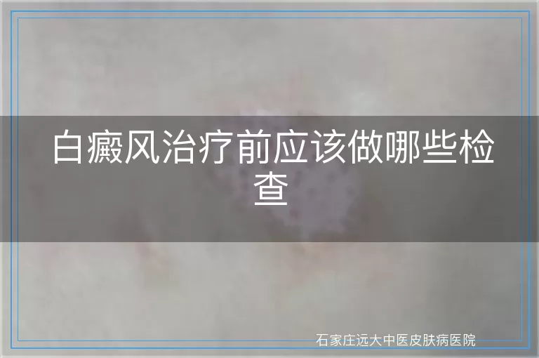 白癜风治疗前应该做哪些检查