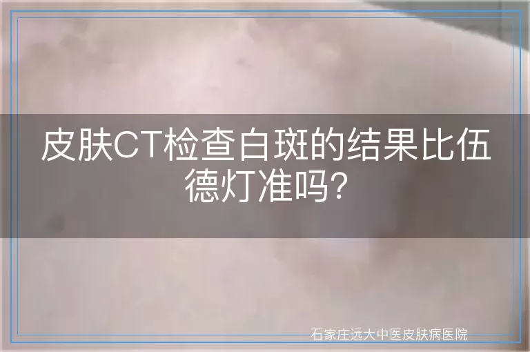 皮肤CT检查白斑的结果比伍德灯准吗？