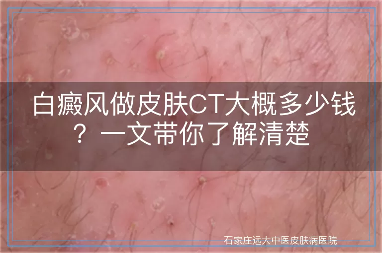 白癜风做皮肤CT大概多少钱？一文带你了解清楚