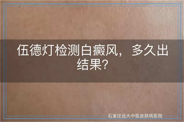 伍德灯检测白癜风，多久出结果？