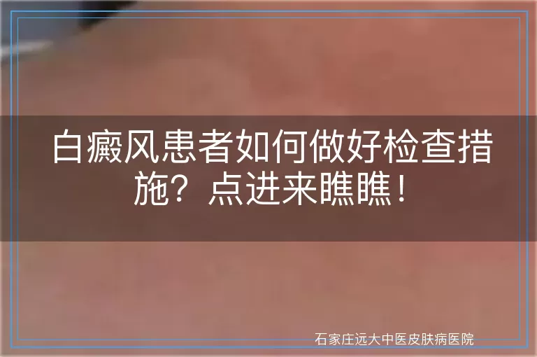 白癜风患者如何做好检查措施？点进来瞧瞧！