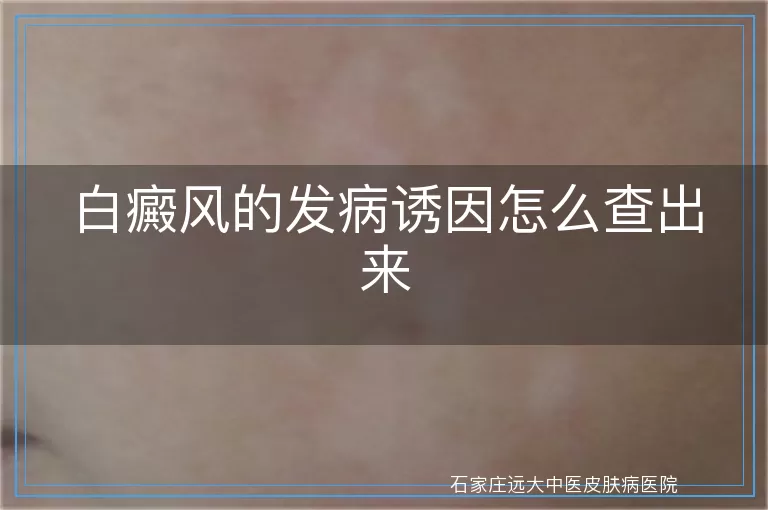 白癜风的发病诱因怎么查出来