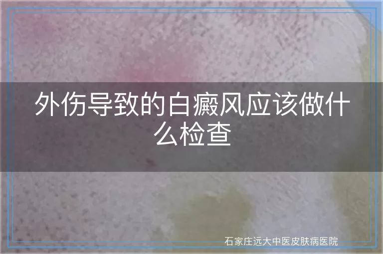 外伤导致的白癜风应该做什么检查