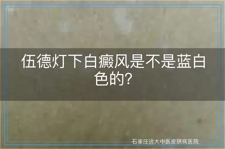 伍德灯下白癜风是不是蓝白色的？