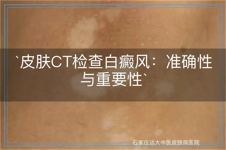 皮肤CT检查白癜风：准确性与重要性