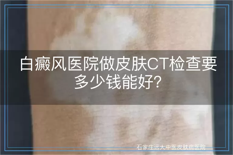 白癜风医院做皮肤CT检查要多少钱能好？