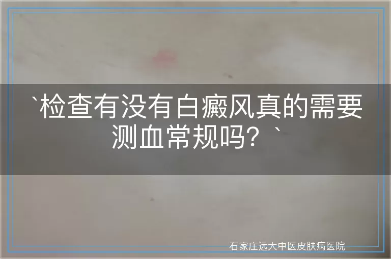 检查有没有白癜风真的需要测血常规吗？