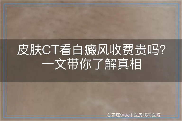 皮肤CT看白癜风收费贵吗？一文带你了解真相