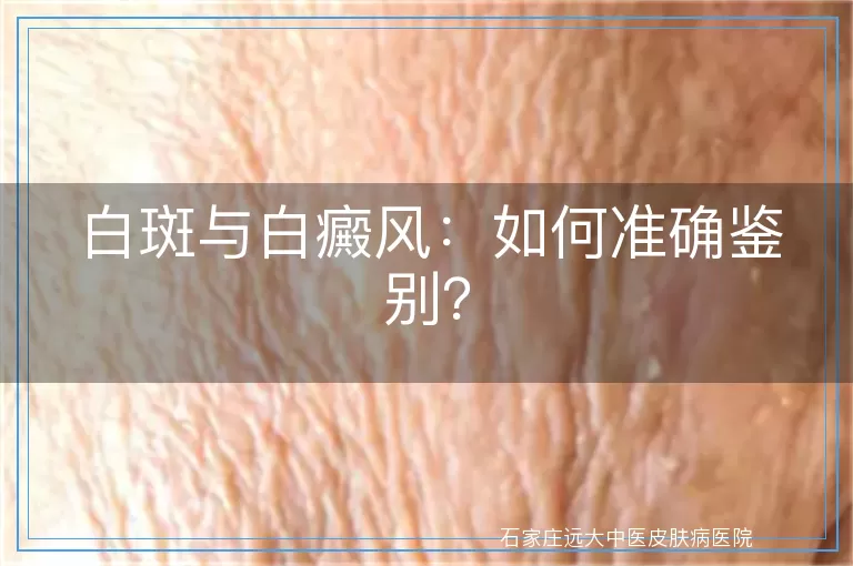 白斑与白癜风：如何准确鉴别？