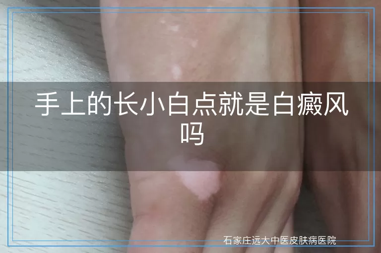 手上的长小白点就是白癜风吗