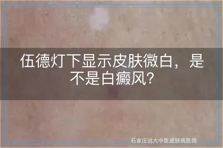 伍德灯下显示皮肤微白，是不是白癜风？