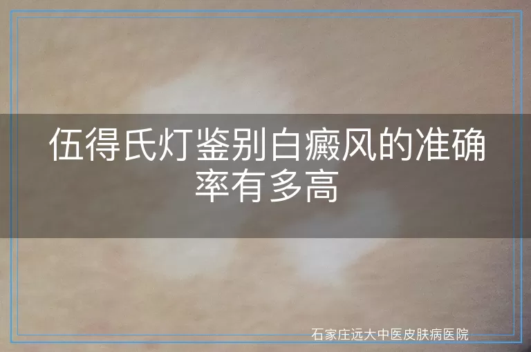 伍得氏灯鉴别白癜风的准确率有多高