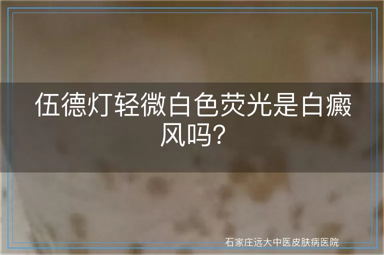 伍德灯轻微白色荧光是白癜风吗？