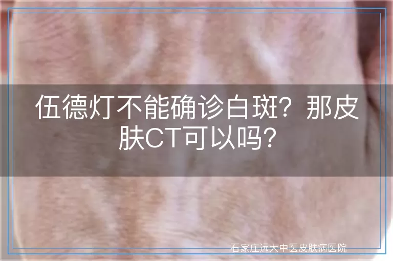 伍德灯不能确诊白斑？那皮肤CT可以吗？