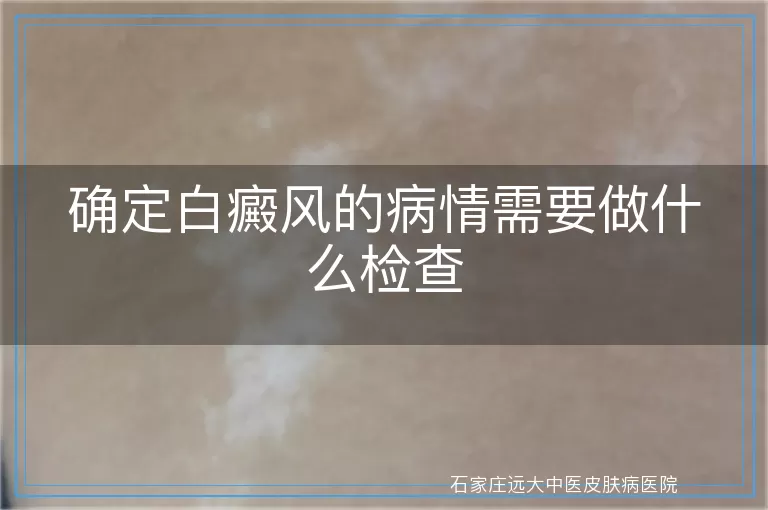 确定白癜风的病情需要做什么检查