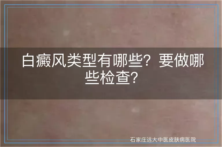 白癜风类型有哪些？要做哪些检查？