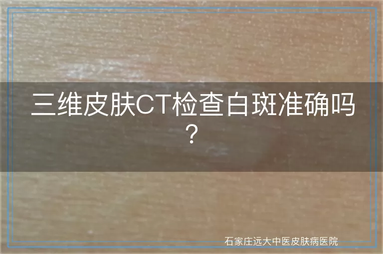 三维皮肤CT检查白斑准确吗？