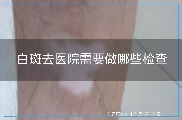 白斑去医院需要做哪些检查