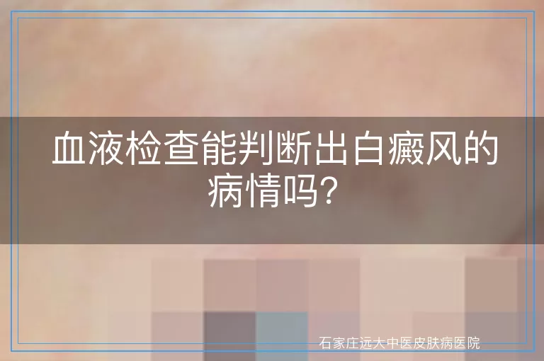 血液检查能判断出白癜风的病情吗？