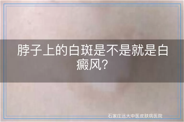 脖子上的白斑是不是就是白癜风？