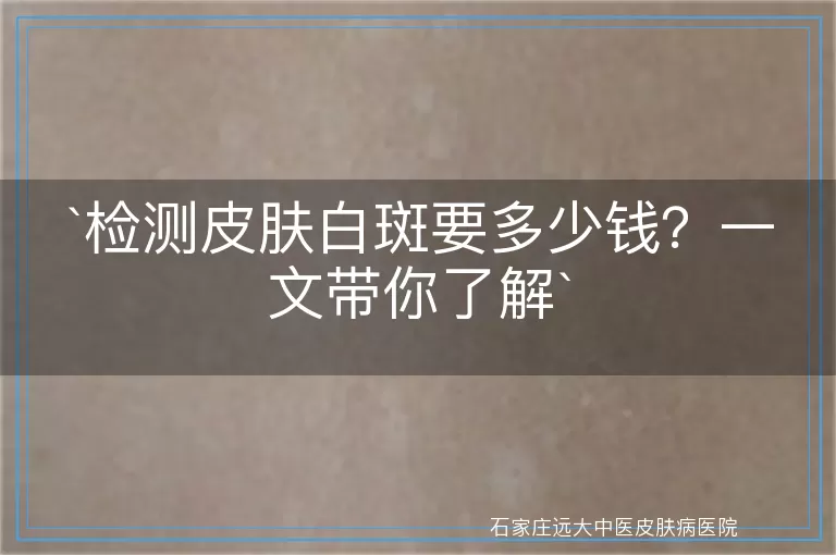 检测皮肤白斑要多少钱？一文带你了解