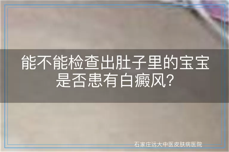 能不能检查出肚子里的宝宝是否患有白癜风？