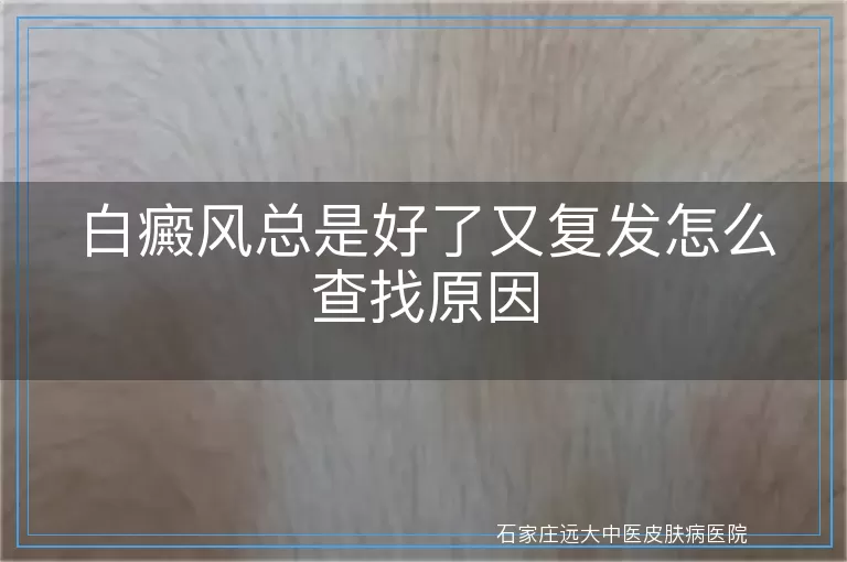 白癜风总是好了又复发怎么查找原因