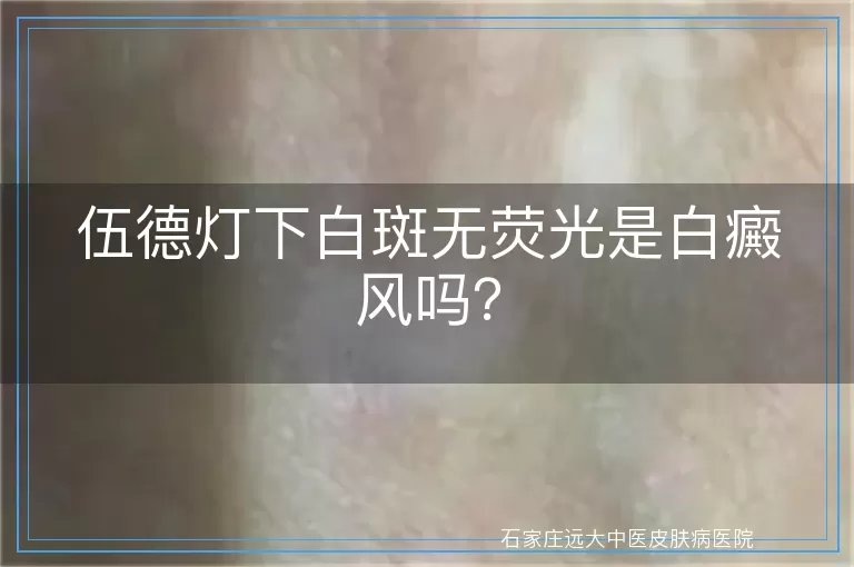 伍德灯下白斑无荧光是白癜风吗？